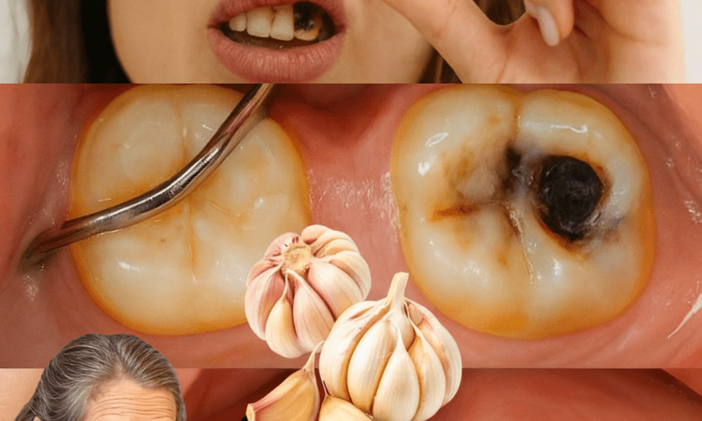 🦷 The Hidden Power of Garlic: Can This Kitchen Staple Help Heal Cavities Naturally? 🦷 The Hidden Power of Garlic: Can This Kitchen Staple Help Heal Cavities Naturally?