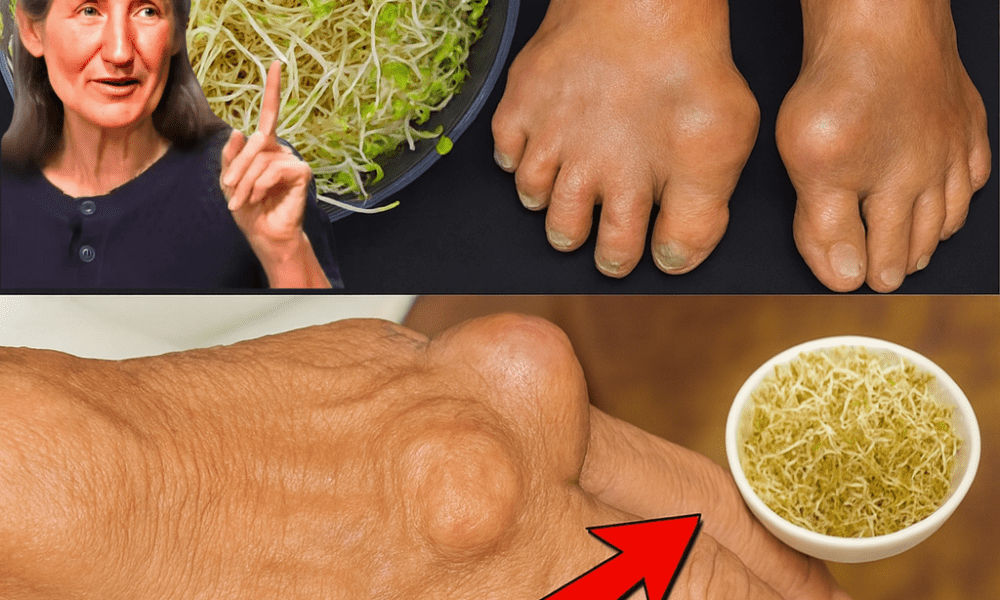 Your Natural Ally Against Kidney Stones and Gout Your Natural Ally Against Kidney Stones and Gout