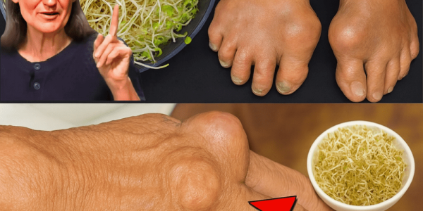 Your Natural Ally Against Kidney Stones and Gout Your Natural Ally Against Kidney Stones and Gout