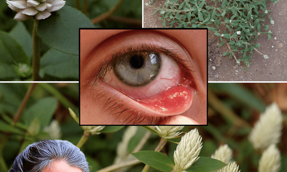 Discover the Miracle Weed: 30 Transformative Benefits of Sessile Joyweed That’ll Change Your Life Discover the Miracle Weed: 30 Transformative Benefits of Sessile Joyweed That’ll Change Your Life