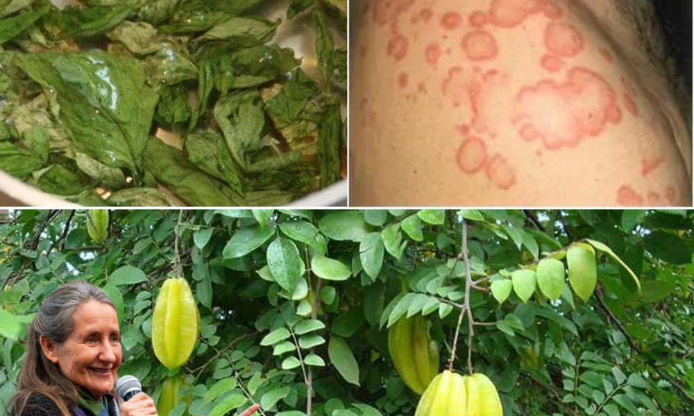 🌿 Star Fruit Leaves Exposed: The Astonishing Remedies for Health and Hives Relief You’ve Been Overlooking