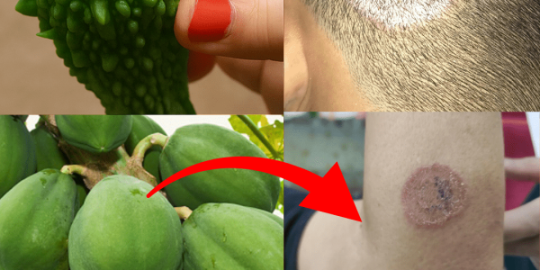 9 Ultimate Home Remedies to Eradicate Fungal Infections Fast and Naturally – dogpjs.com