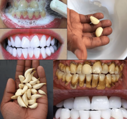 Transform Your Smile with Garlic