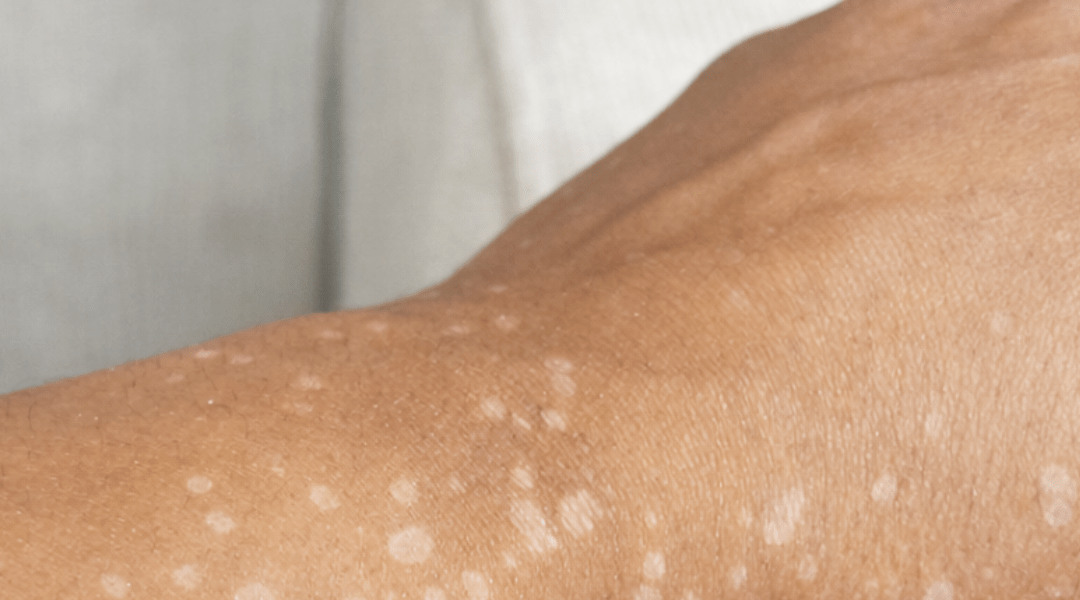 Have You Noticed Small White Spots on Your Arms or Legs? Here’s What You Need to Know About Them Have You Noticed Small White Spots on Your Arms or Legs? Here’s What You Need to Know About Them
