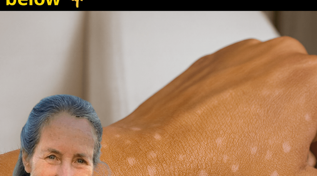 Small White Spots On Your Arms Or Legs: What They Could Mean And When To Worry Small White Spots On Your Arms Or Legs: What They Could Mean And When To Worry