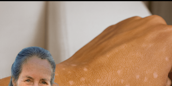 Small White Spots On Your Arms Or Legs: What They Could Mean And When To Worry