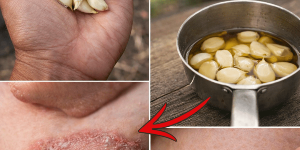Garlic and Olive Oil: Exploring a Traditional Home Approach for Soothing Fungal Skin Discomfort Naturally