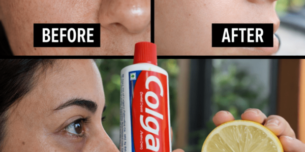 Toothpaste and Lemon for Dark Circles: Does It Really Work? (Dermatologist-Backed Truth)