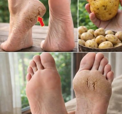 Could a Simple Potato Help Soothe Dry, Cracked Heels? A Surprising Kitchen Tip You Might Want to Try Could a Simple Potato Help Soothe Dry, Cracked Heels? A Surprising Kitchen Tip You Might Want to Try