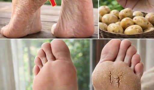 Could a Simple Potato Help Soothe Dry, Cracked Heels? A Surprising Kitchen Tip You Might Want to Try