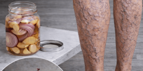 Say Goodbye to Varicose Veins Naturally: Exploring Garlic, Onion, and Olive Oil for Potential Leg Comfort and Circulation Support