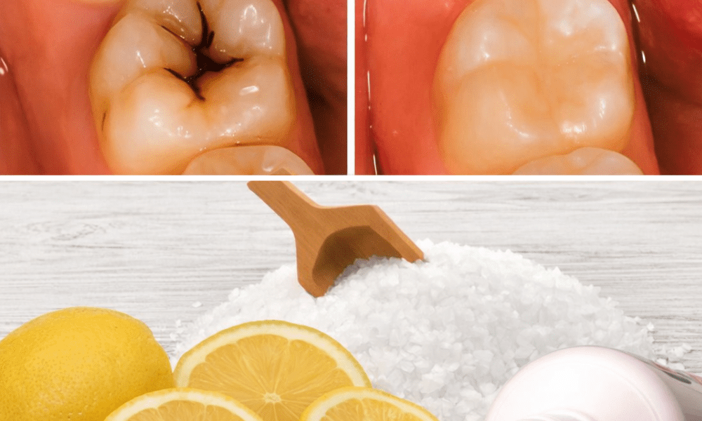 How to Naturally Repair a Cavity and Strengthen Your Teeth