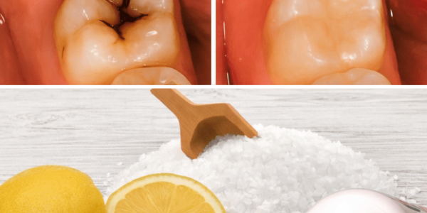 How to Naturally Repair a Cavity and Strengthen Your Teeth