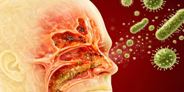 Eliminate Mucus, Phlegm in the Throat and Nose, and Rhinitis Naturally: Powerful Home Remedies Eliminate Mucus, Phlegm in the Throat and Nose, and Rhinitis Naturally: Powerful Home Remedies