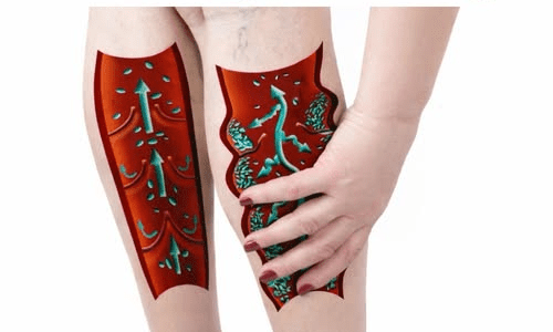 If You Have Poor Circulation, Cold Feet or Varicose Veins, Start Doing These 6 Things