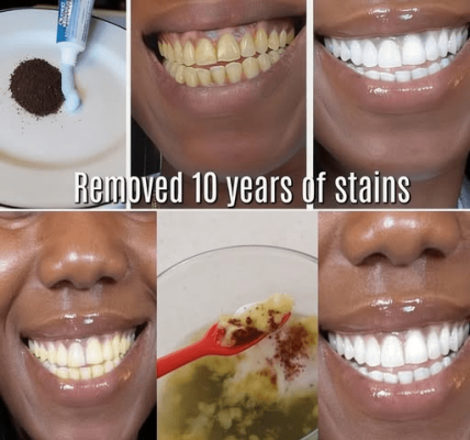 In Just 2 Minutes, Remove 10 Years of Teeth Stains – The Natural Whitener That Actually Works
