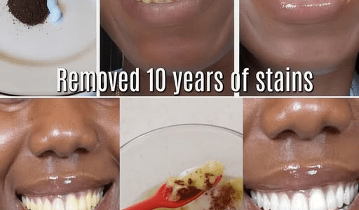 In Just 2 Minutes, Remove 10 Years of Teeth Stains – The Natural Whitener That Actually Works