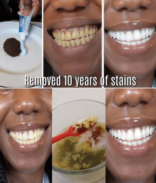 In Just 2 Minutes, Remove 10 Years of Teeth Stains – The Natural Whitener That Actually Works