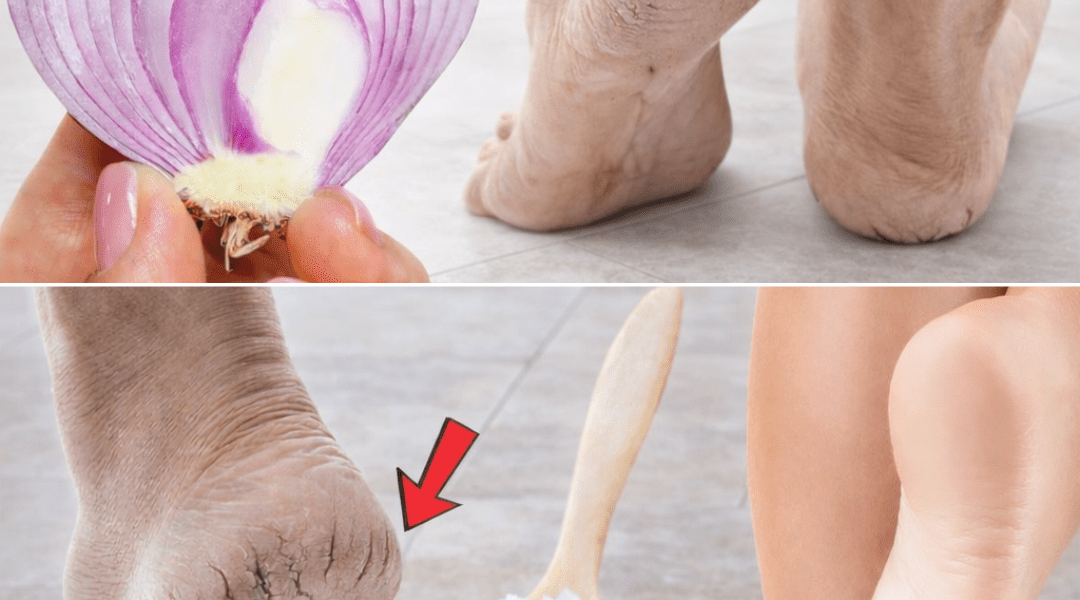 5 Natural Home Remedies for Cracked Heels (That Actually Work)