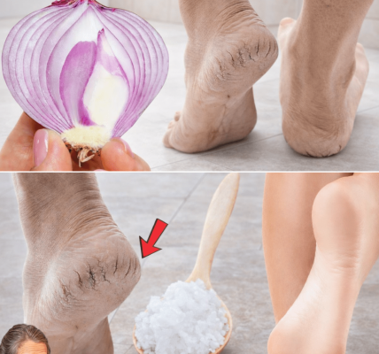 5 Natural Home Remedies for Cracked Heels (That Actually Work)