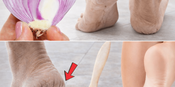 5 Natural Home Remedies for Cracked Heels (That Actually Work) 5 Natural Home Remedies for Cracked Heels (That Actually Work)