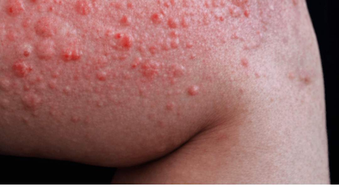 Why Do Hives Suddenly Appear on Your Skin? Surprising Triggers You May Not Expect