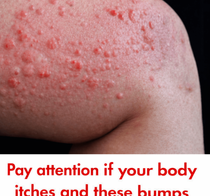 Why Do Hives Suddenly Appear on Your Skin? Surprising Triggers You May Not Expect