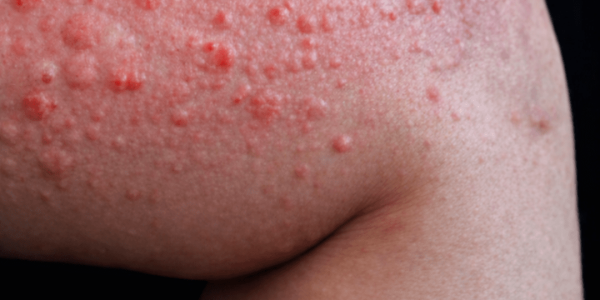 Why Do Hives Suddenly Appear on Your Skin? Surprising Triggers You May Not Expect