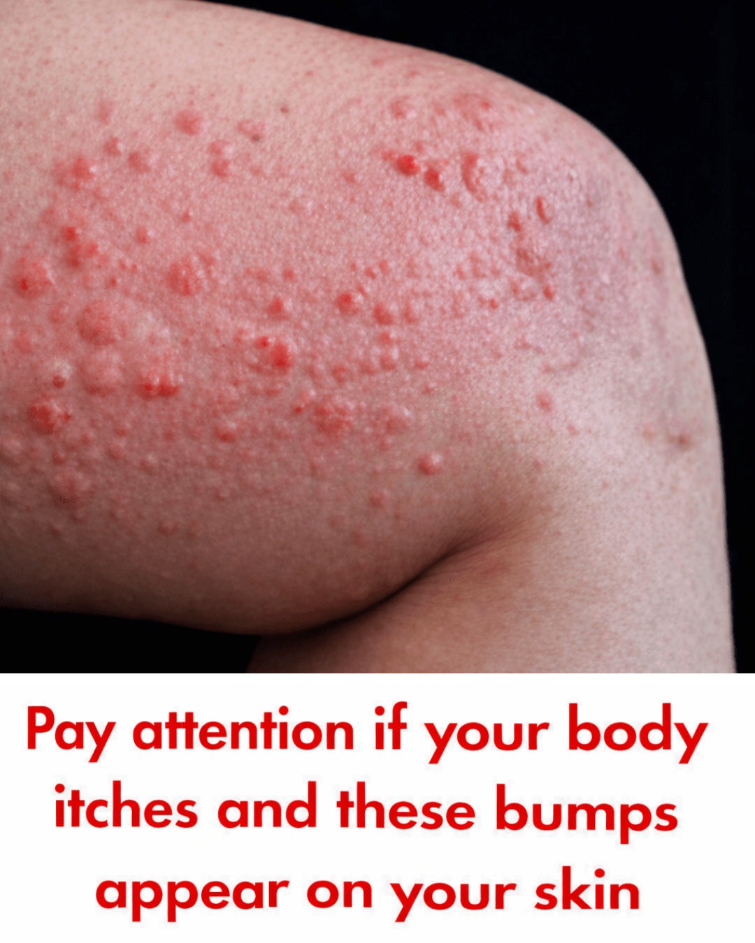 Why Do Hives Suddenly Appear on Your Skin? Surprising Triggers You May Not Expect