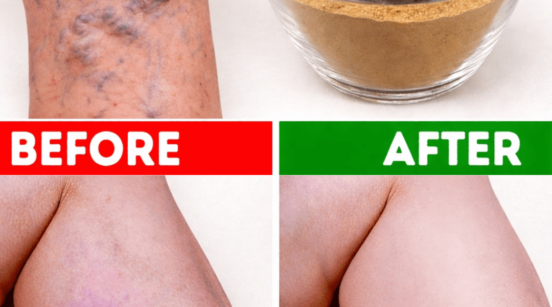 10 Natural Ways to Help Reduce the Appearance of Varicose Veins and Improve Blood Flow 10 Natural Ways to Help Reduce the Appearance of Varicose Veins and Improve Blood Flow