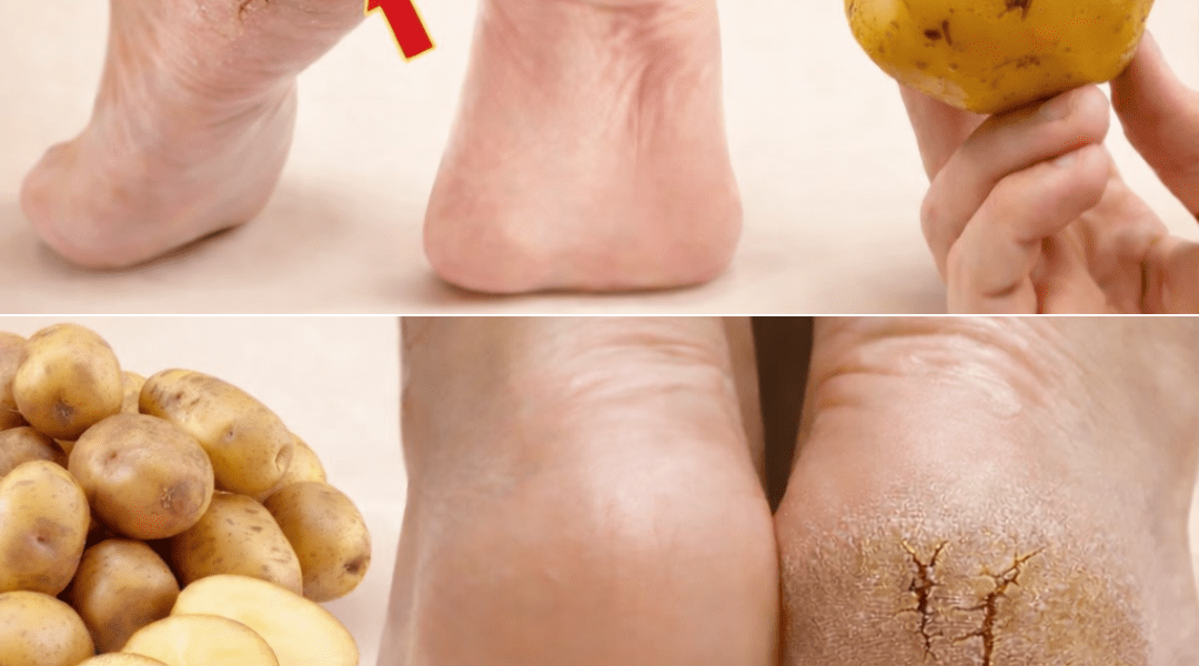 Just ONE Potato Can Help You Say Goodbye to Cracked Heels for Good