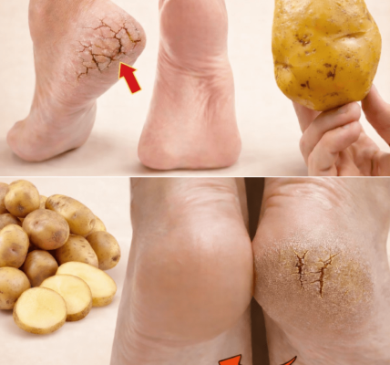 Just ONE Potato Can Help You Say Goodbye to Cracked Heels for Good Just ONE Potato Can Help You Say Goodbye to Cracked Heels for Good